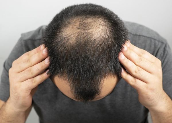 Low Iron and Hair Loss – Symptom, Causes and Treatments